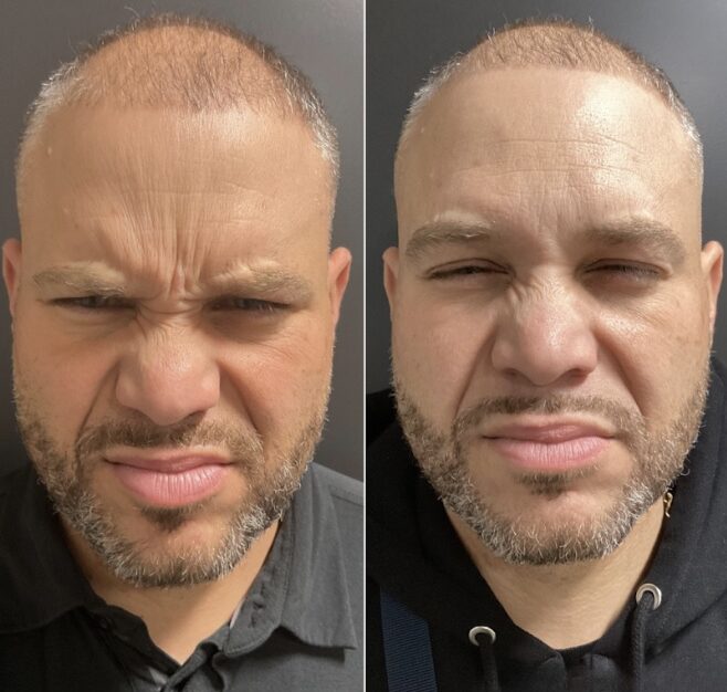 Before and after of front facing man squinting